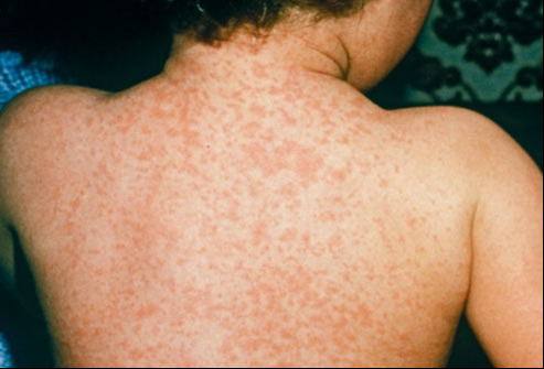 СЭРЭМЖЛҮҮЛЭГ: Менингококкт халдвараас сэргийлэх энгийн аргуудын нэг нь бэлтгэсэн уусмалаар хоолойгоо зайлах юм